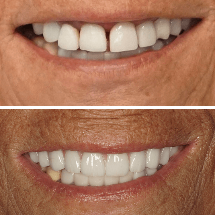 before and after dental procedure close u p
