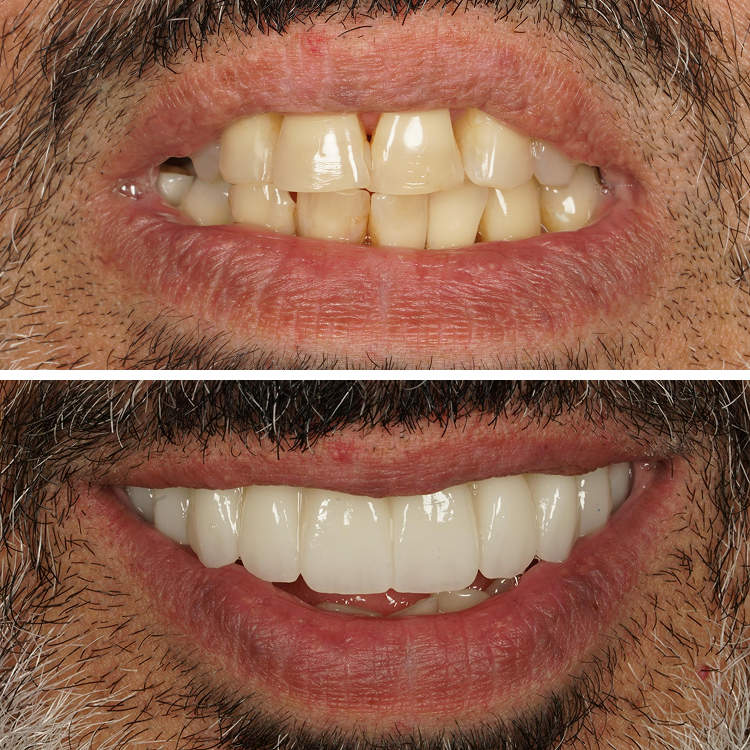 Before and After Hybrid Dark Mustache