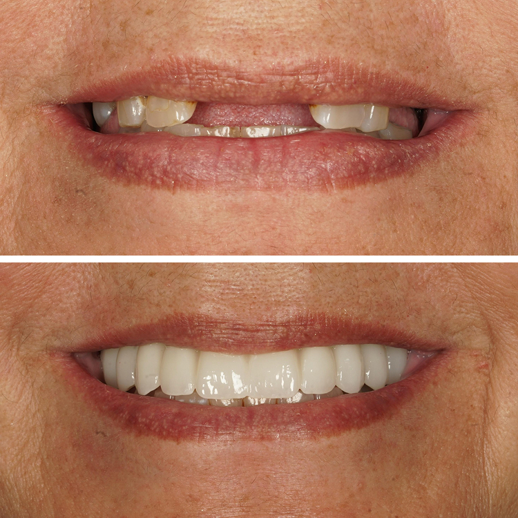 Before and After Hybrid - Front Teeth