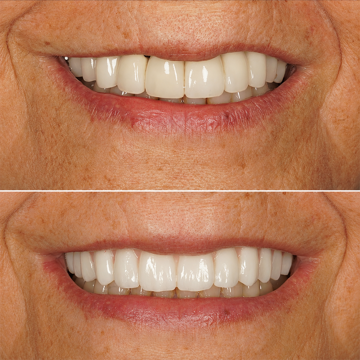 Before and after hybrid
