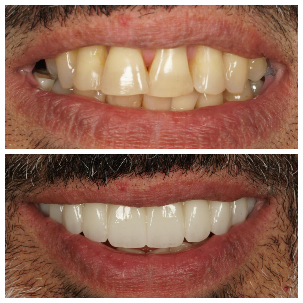 before and after smile makeover