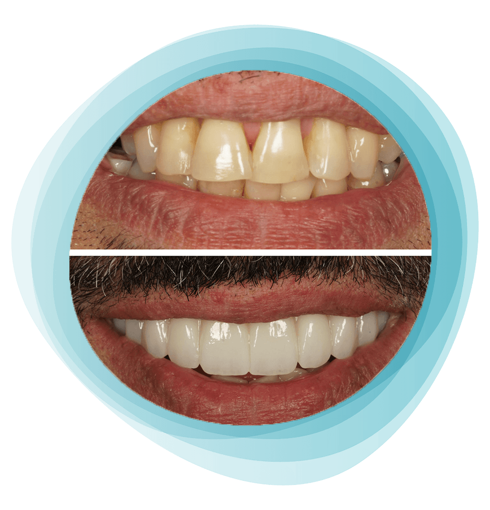 before and after smile makeover